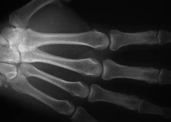 Voici ce qui se passe dans vos articulations lorsque vous les faites craquer