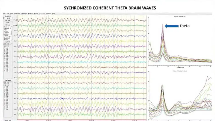 Visualisation d'un tracé EEG montrant une activité cérébrale en phase synchronisée dans les états d'ondes alpha, illustrant un état de haute cohérence.