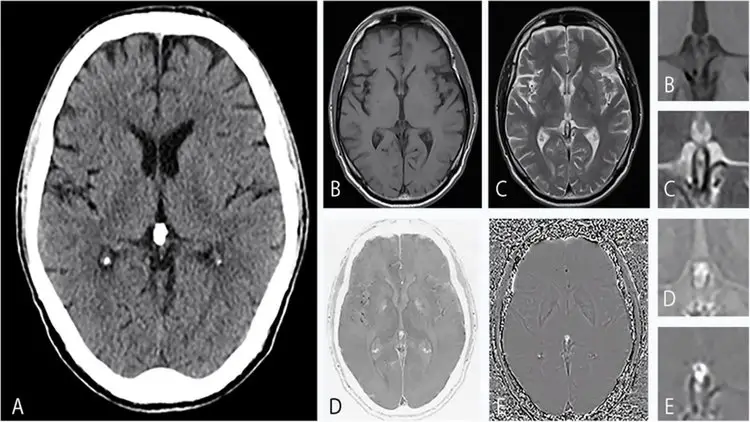 Imagerie médicale montrant une glande pinéale calcifiée au centre du cerveau