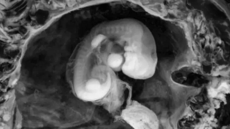 Visualisation par scanner d'un fœtus à l'intérieur de la cavité abdominale de la momie, une découverte majeure qui remet en question la nature de l'organisme.