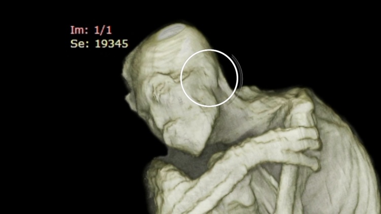 Gros plan sur l'imagerie médicale du crâne de Maria, mettant en évidence l'articulation de la mâchoire et l'absence d'oreilles externes.