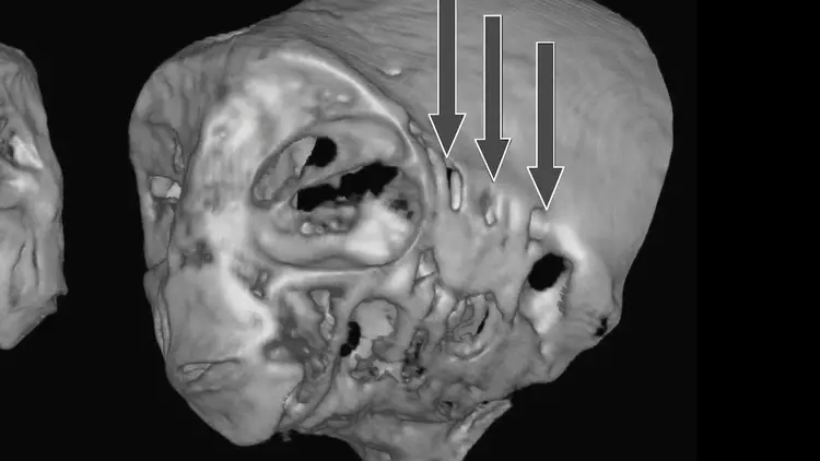 Analyse tomographique du crâne montrant des orifices spécifiques, une caractéristique anatomique absente chez les êtres vivants connus.